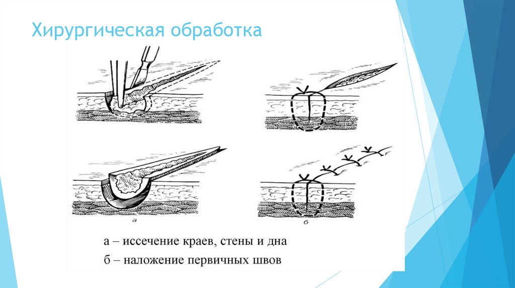 Хирургическая обработка виды. Пхо раны этапы операции.