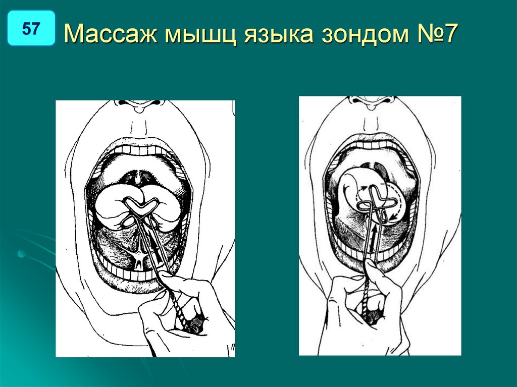 Массаж зондами. Зонд для массажа языка. Массаж мышц языка зондом. Зондовый логопедический массаж языка. Логопедический массаж языка схема.