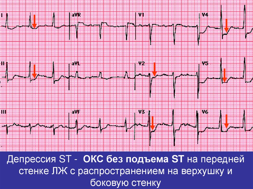Депрессию инфаркт. ЭКГ Окс без подъема сегмента St. Острый коронарный синдром без подъема сегмента St ЭКГ. ЭКГ острый коронарный синдром инфаркт миокарда. Подъем сегмента St в AVR на ЭКГ.