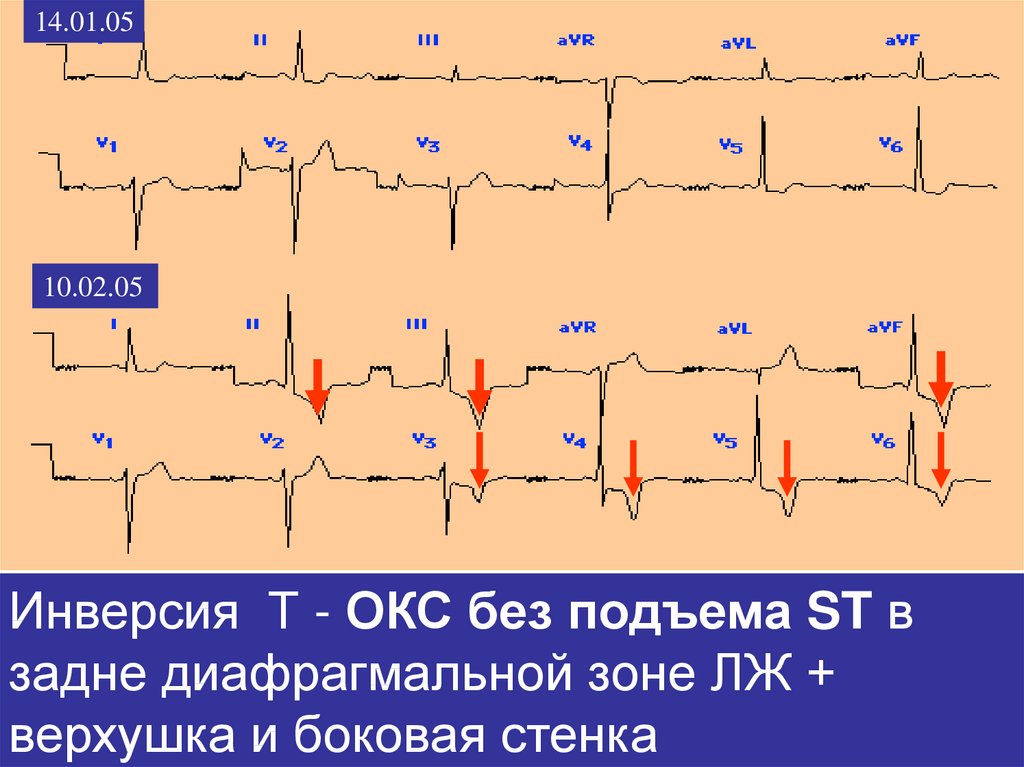 Экг признаки окс