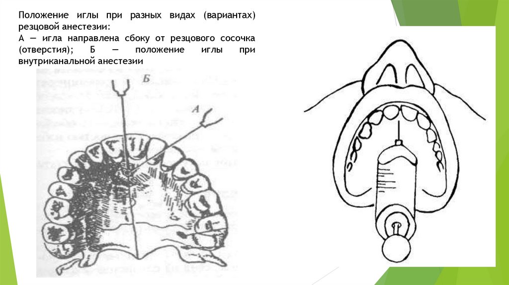 Анестезия верхней и нижней челюсти