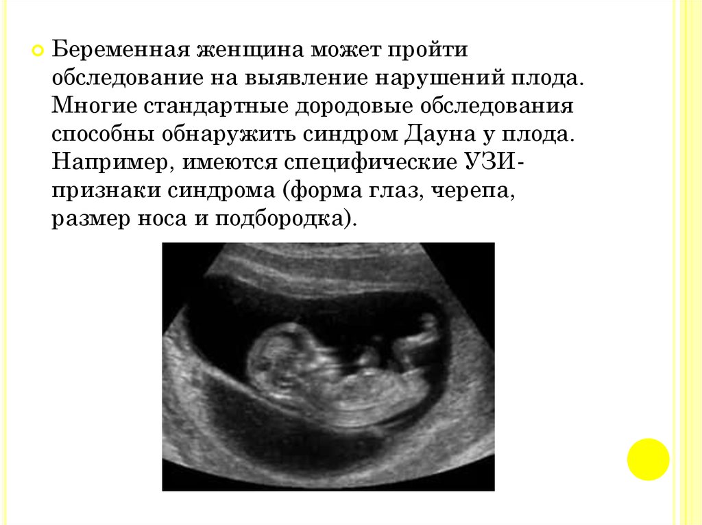 Синдромы узи. Синдром Дауна на УЗИ 12 недель. УЗИ плода на 12 неделе беременности с синдромом Дауна. УЗИ плода с синдромом Дауна в 3 триместре. Признаки синдрома Дауна на УЗИ 12 недель беременности.