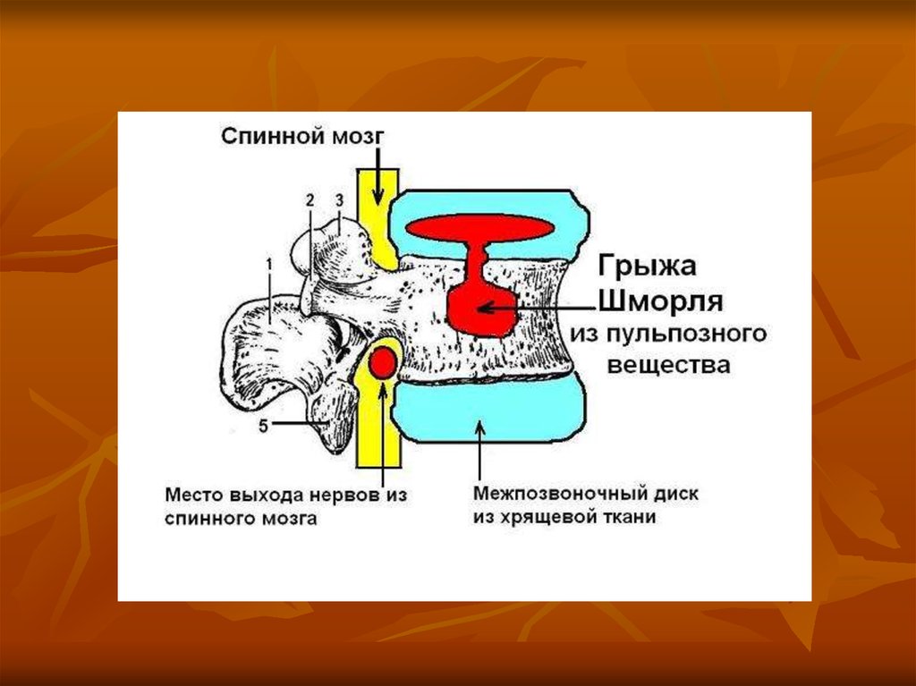 Грыжа шморля. Единичные грыжи Шморля. Грыжи Шморля презентация.