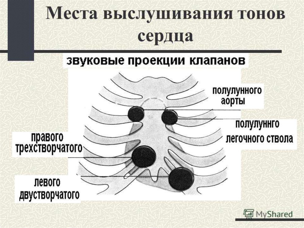 Аорта выслушивается. Точки выслушивания тонов сердца. Места выслушивания тонов клапанов сердца. Схема прослушивания тонов сердца. Аускультация сердца точки выслушивания схема.