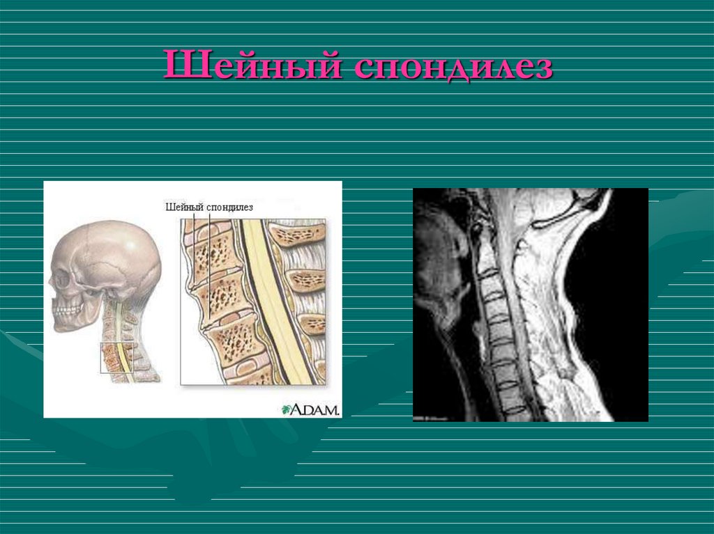 Спондилез это простыми. Шейный спондилез. Травматический спондилез.