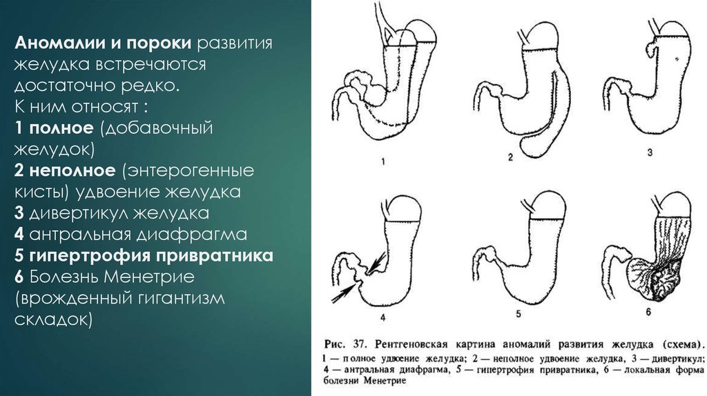 Пороки развития жкт