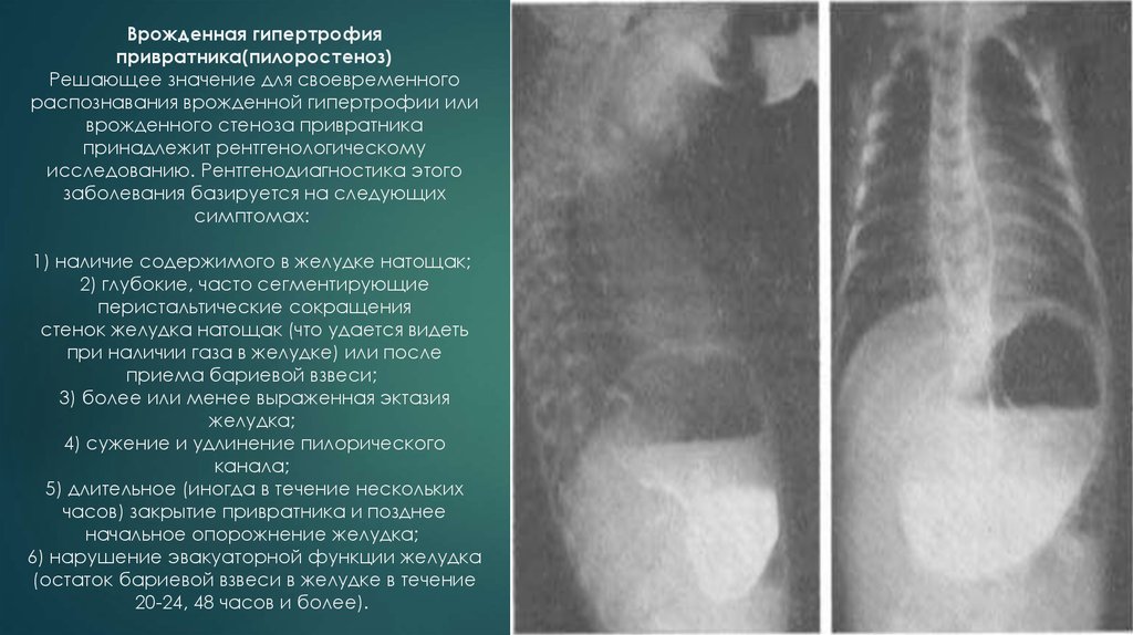 Синдром стеноза. Пилоростеноз и пилороспазм рентген. Пилорический стеноз желудка рентген. Гипертрофический пилоростеноз.