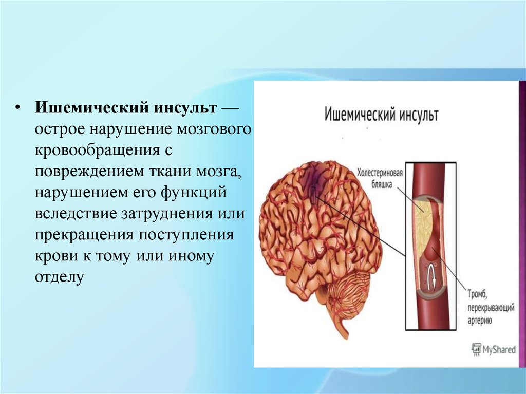 Что такое ишемический инсульт головного мозга. Инсульт острое нарушение мозгового кровообращения. Ишемический церебральный инсульт. Ишемический инсульт ОНМК неврология.