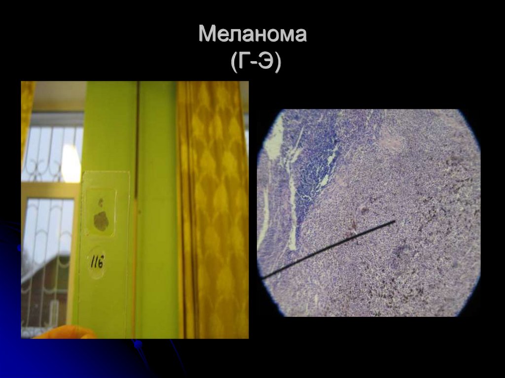 Меланома (Г-Э)