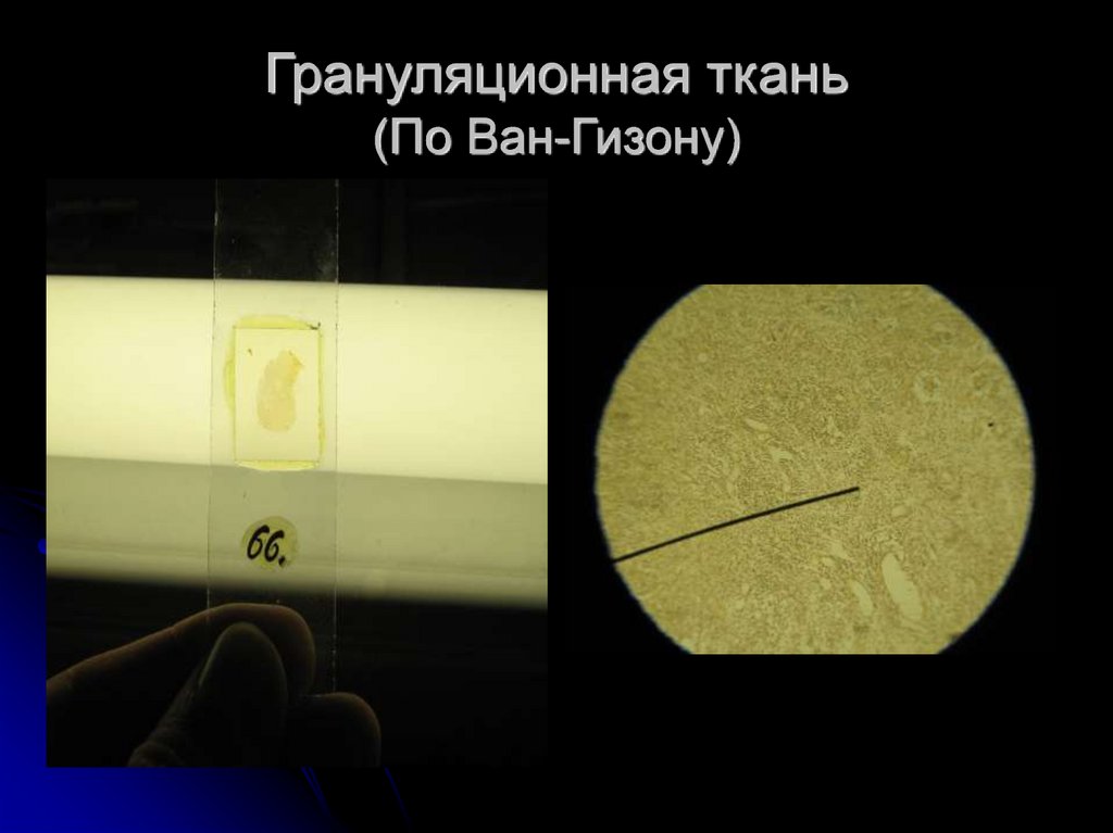 Грануляционная ткань (По Ван-Гизону)