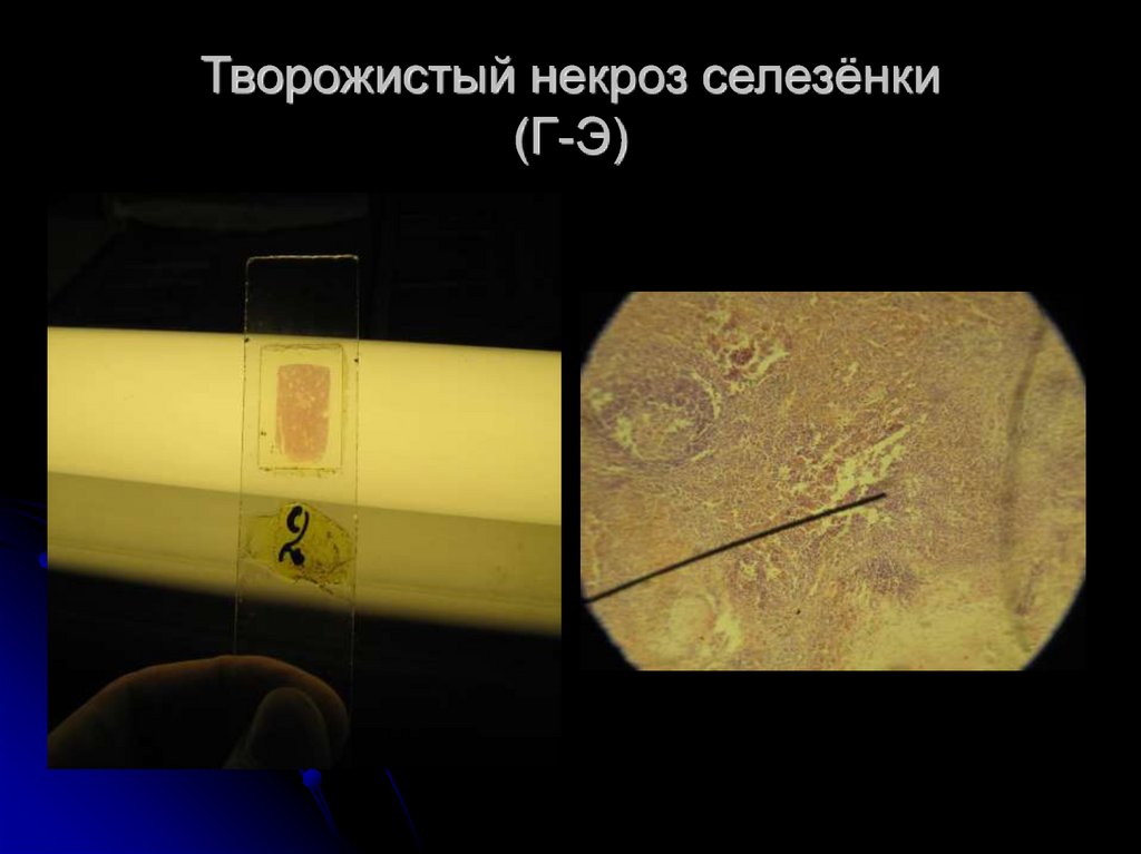 Творожистый некроз селезёнки (Г-Э)