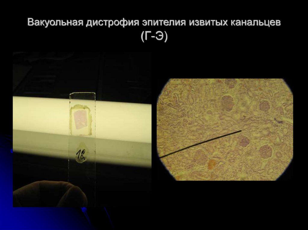 Вакуольная дистрофия эпителия извитых канальцев (Г-Э)