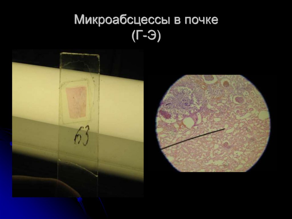 Микроабсцессы в почке (Г-Э)