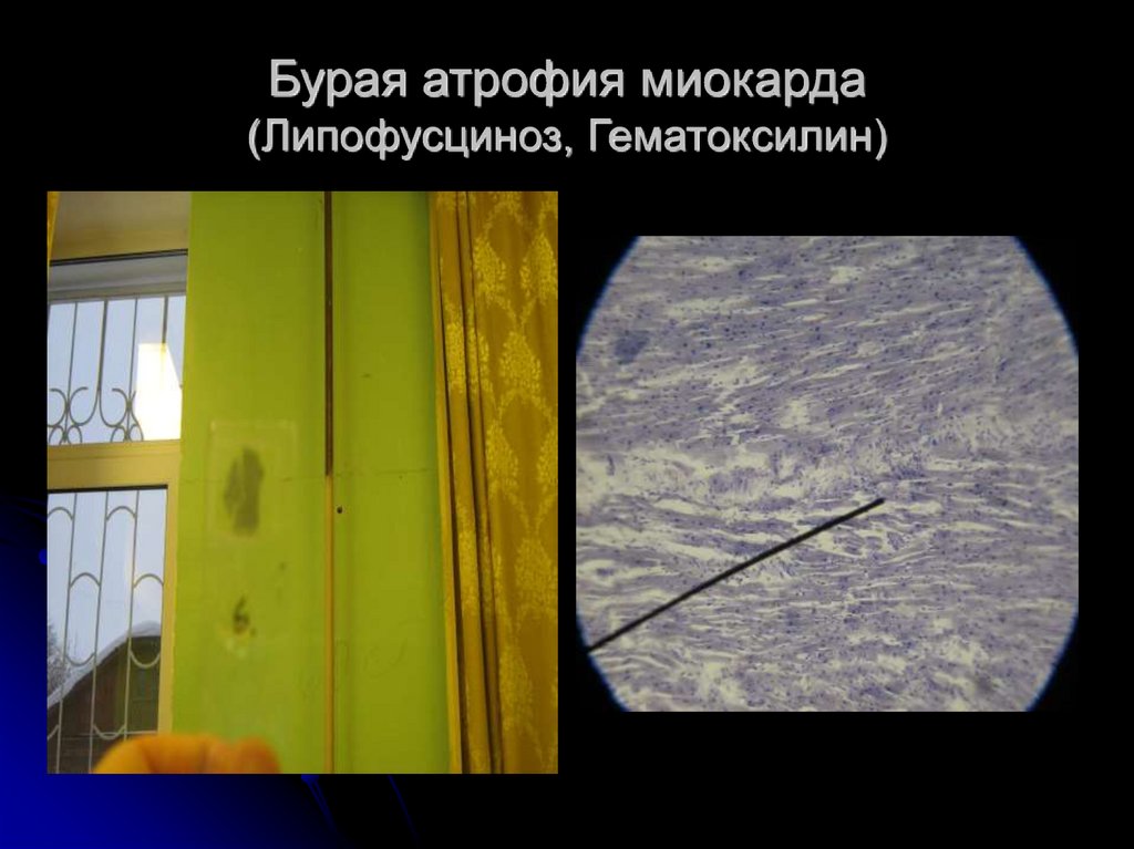 Бурая атрофия миокарда (Липофусциноз, Гематоксилин)