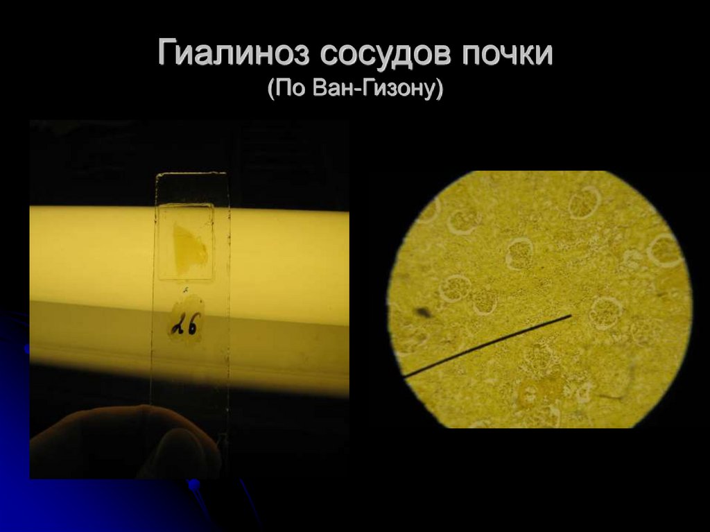 Гиалиноз сосудов почки (По Ван-Гизону)