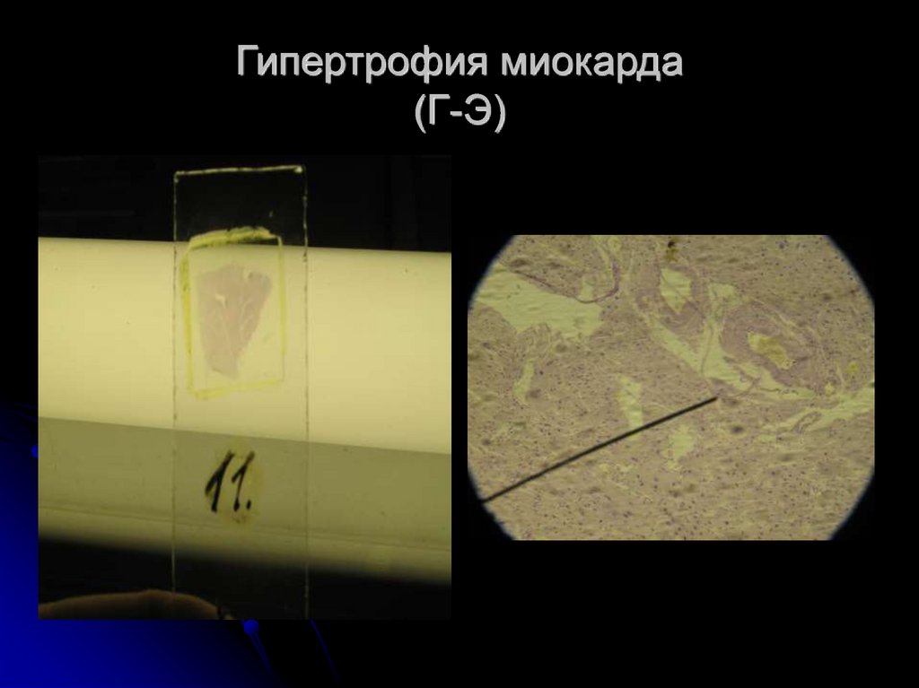 Гипертрофия миокарда (Г-Э)