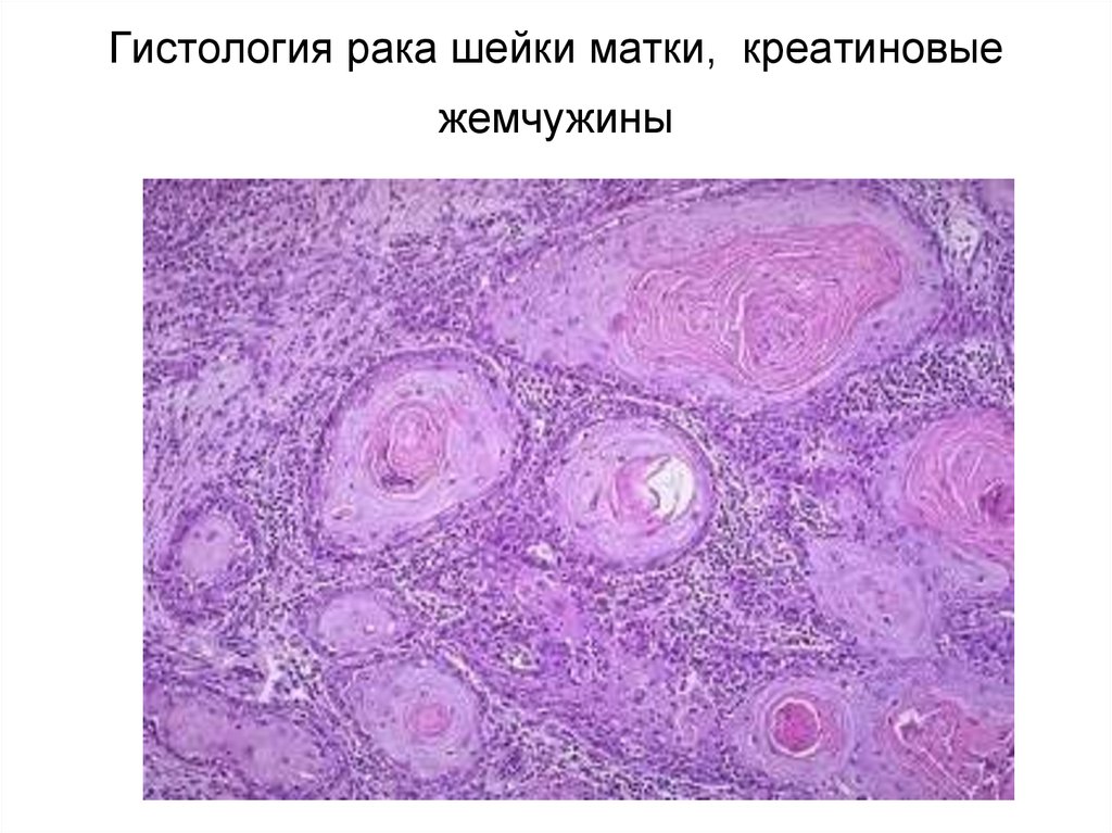 Умеренно дифференцированный плоскоклеточный рак. Squamous Cell carcinoma гистология. Плоскоклеточная карцинома кожи гистология. Плоскоклеточная папиллома пищевода гистология. Раковые Жемчужины микропрепарат.