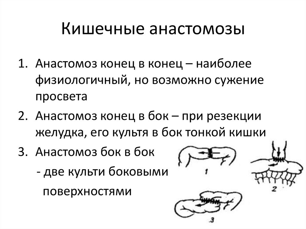 Кишечные анастомозы. Анастомоз кишечника классификация. Виды кишечных анастомозов. Этапы формирования кишечного анастомоза.