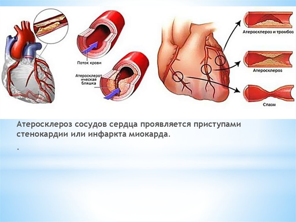Инфаркт миокарда бляшка