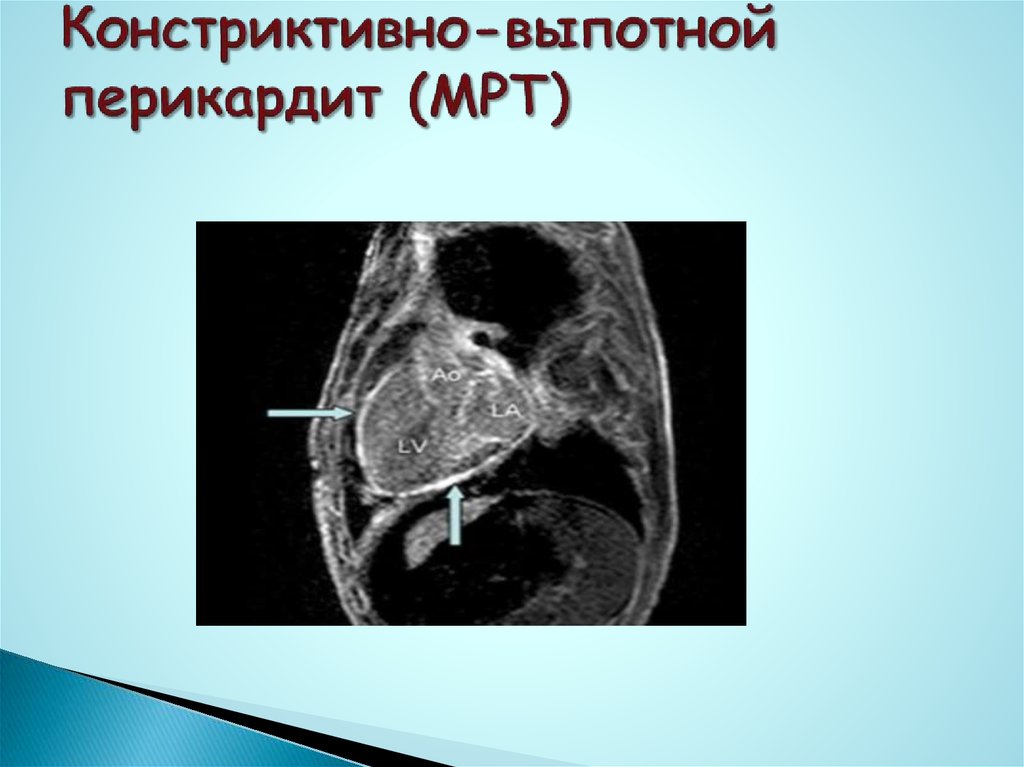Выпотной перикардит. Экссудативный перикардит мрт. Констриктивный перикардит макропрепарат. Перикардит презентация. Экссудативный перикардит кт.