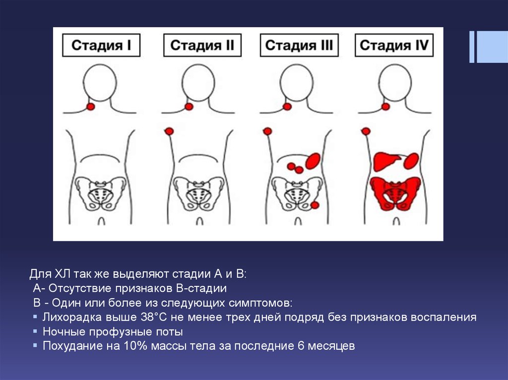 Стадии лимфомы. Стадии лимфом самая легкая.