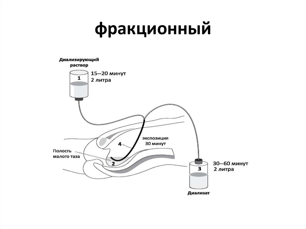 Перитонеальный диализ схема