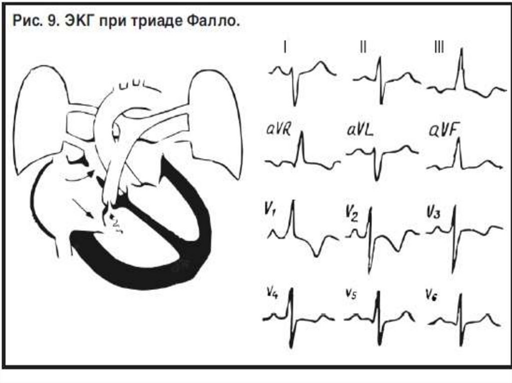 Синдром эйзенменгера презентация