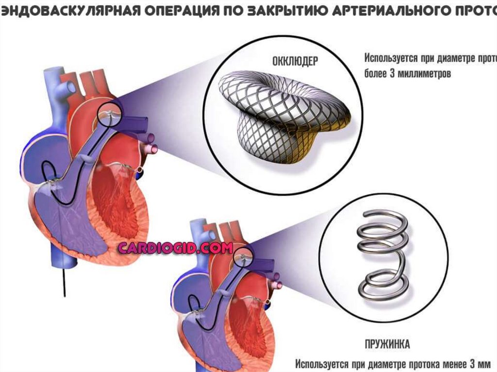 Как клапан делает операция. Окклюдер открытого артериального протока. Операцию при открытом артериальном протоке (ОАП) проводят. Открытый артериальный проток окклюдер. Открытый боталлов проток операция.