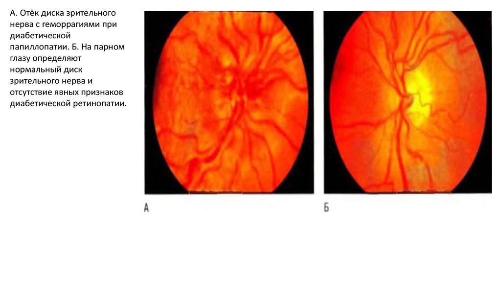 Диск зрительного нерва. Отечный диск зрительного нерва. Отечныйдиск зрительногт нерва. Проминенция диска зрительного нерва.