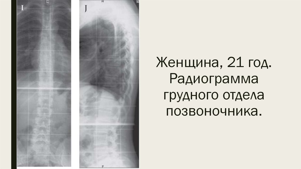 Синдром шихана презентация