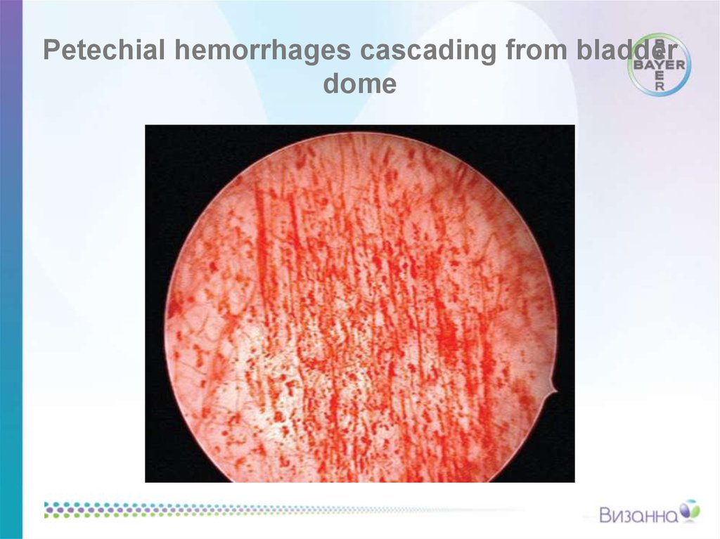 Petechial hemorrhages cascading from bladder dome