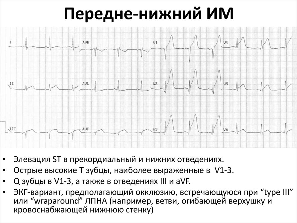 Передне нижний. Отведения нижней стенки. Нижний им. Инфаркт нижней стенки какие отведения. Нижний им с желудочковой.