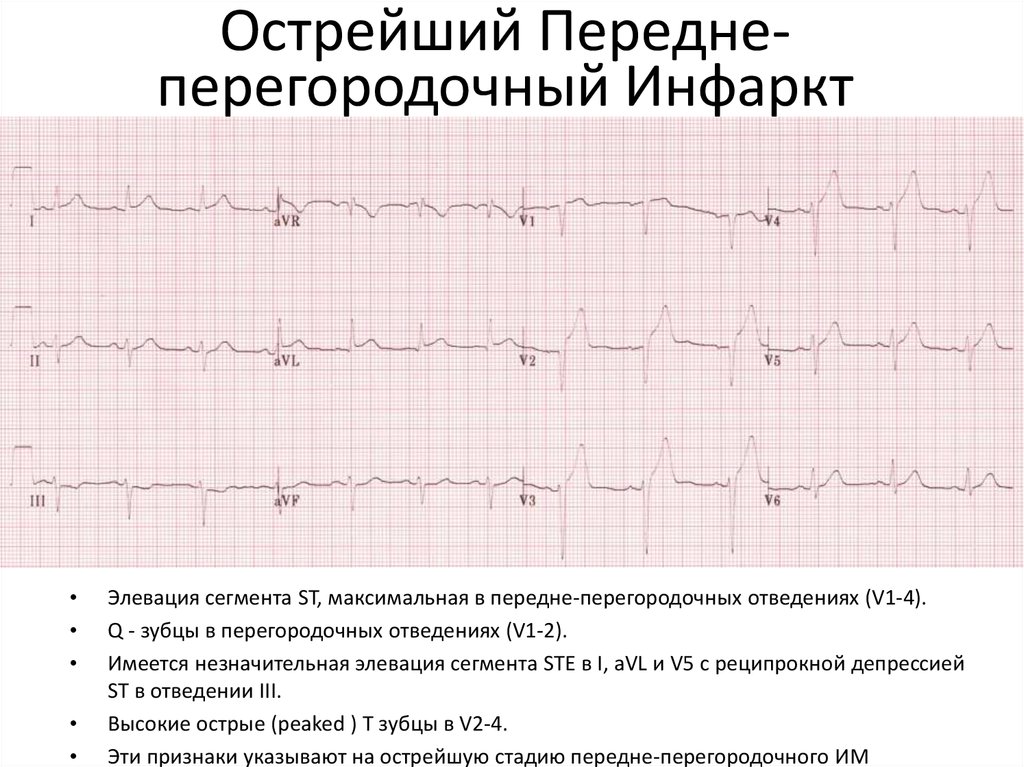 Изменение миокарда перегородочной области. Инфаркт переднеперегородочной области на ЭКГ. Острый трансмуральный инфаркт передней стенки на ЭКГ. Инфаркт передней стенки на ЭКГ. Острый трансмуральный инфаркт ЭКГ.