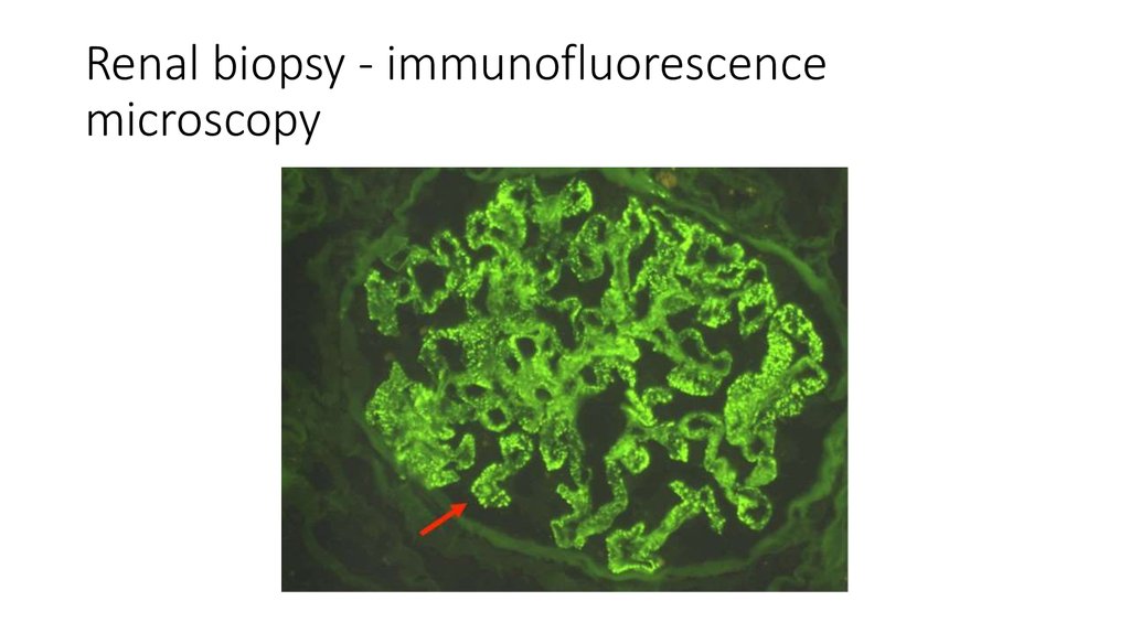 Renal biopsy - immunofluorescence microscopy