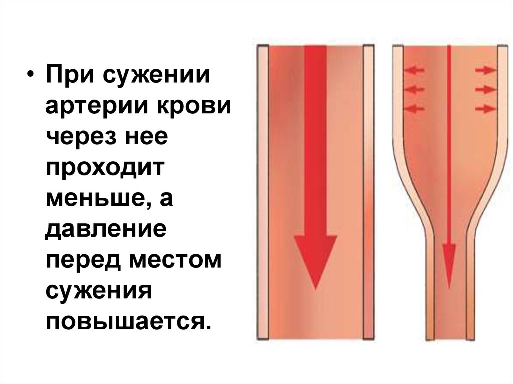 При сужении сосудов давление. Степени стеноза артерий. В старости артерии сужаются или расширяются. Методы расчета стенозов сосудов. Стеноз сосуда высчитать.