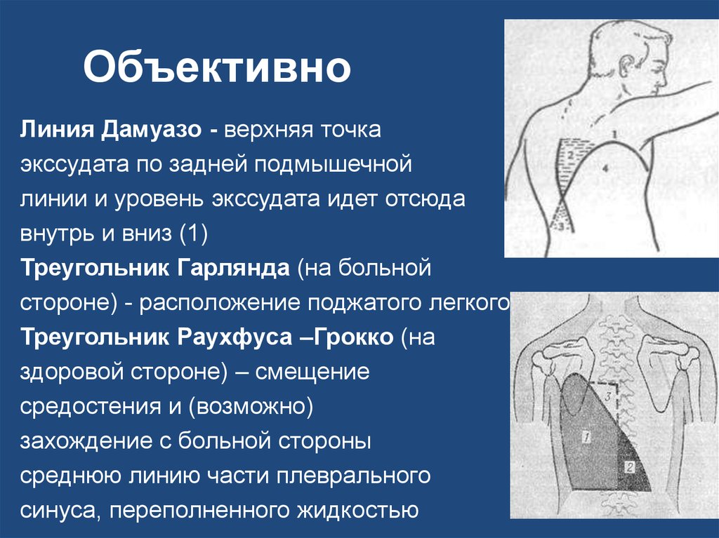 Гидроторакс легких карта вызова