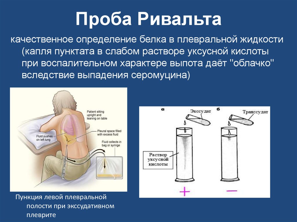 Реакция жидкость жидкость. Проба Ривольта в плевральной жидкости. Алгоритм выполнения пробы Ривальта. Проба Ривальта положительная. Проба Ривальта белок.