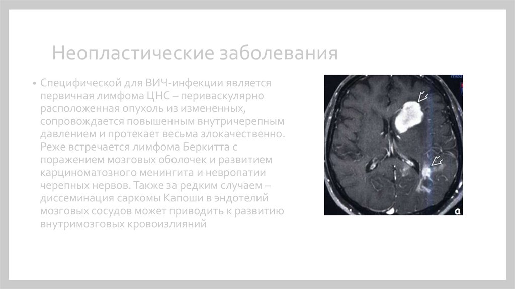 Неопластический процесс в легких. Неопластические расстройства. Неопластический процесс. Неопластические болезни что такое. Болезнь неопластическая генерализованная.