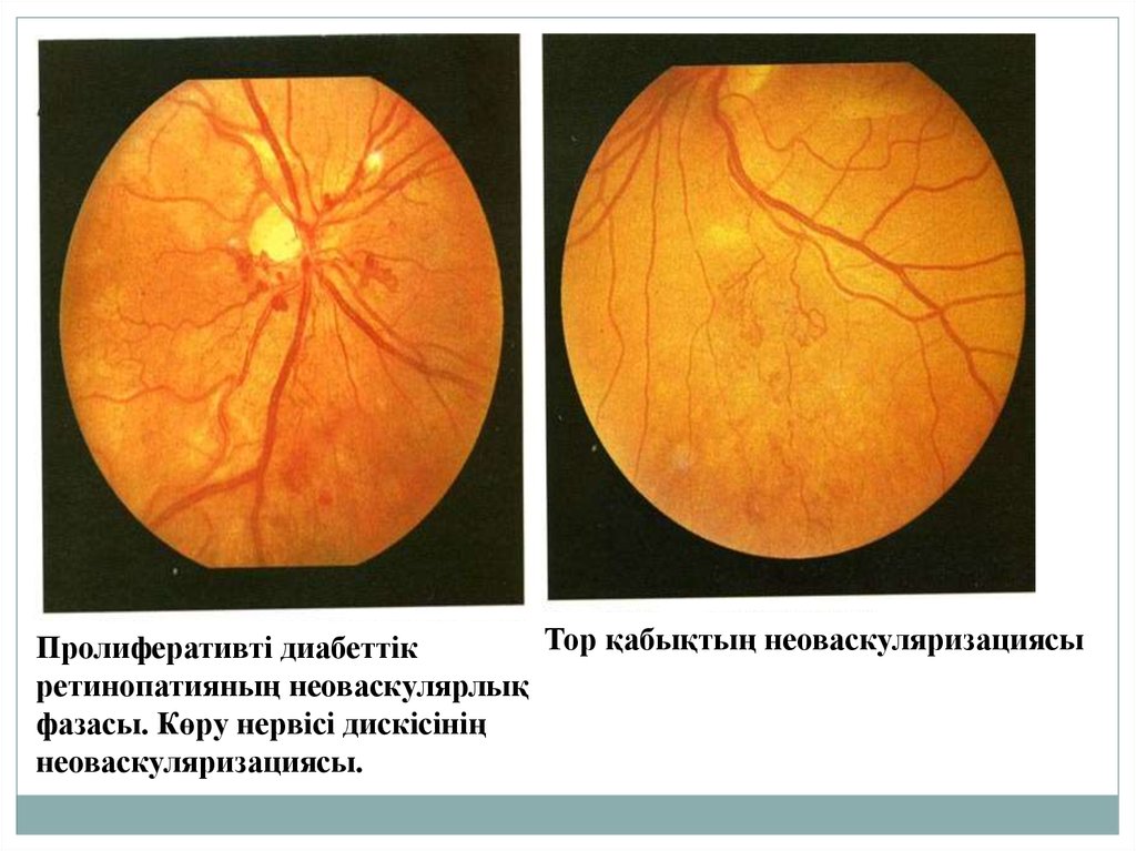 Диабеттік ретинопатия презентация