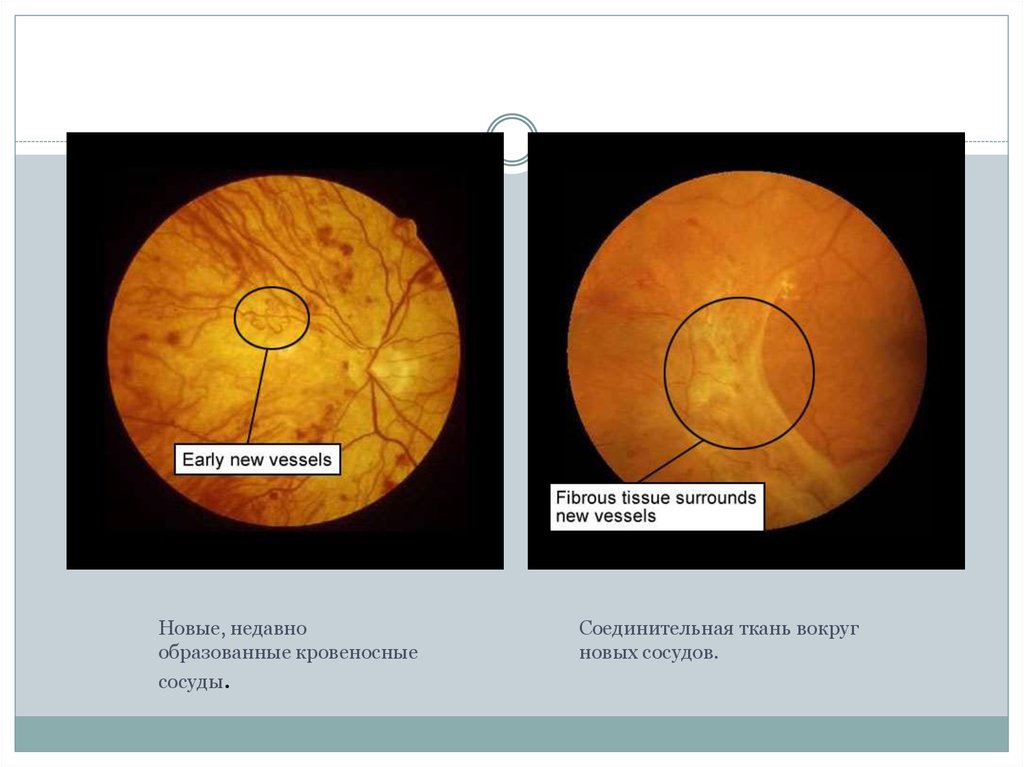 Диабеттік ретинопатия презентация