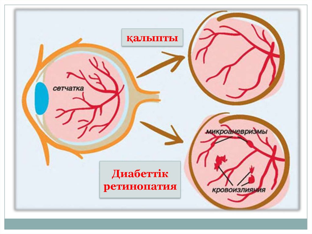 Диабеттік ретинопатия презентация