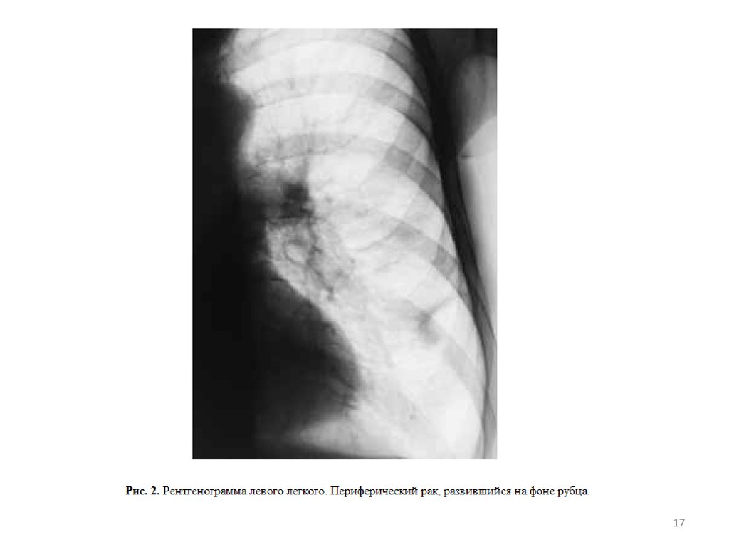 Периферический рак легкого. Рентгенодиагностика легких. Лучевая картина опухолей легких. Опухоль с распадом на рентгене. Периферический ра легкого рентег.