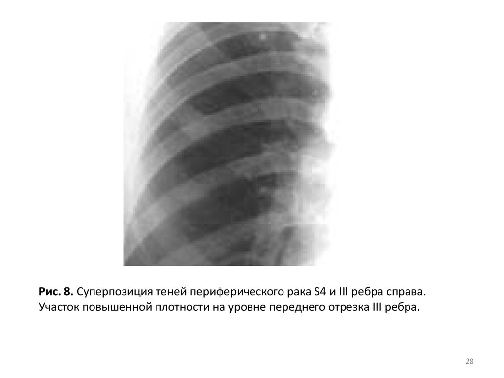 3 ребра справа. Рентгенодиагностика легких. Опухоли ребер рентгенодиагностика. Суперпозиция рентген. Очаговая тень на уровне переднего отрезка 1 ребра.