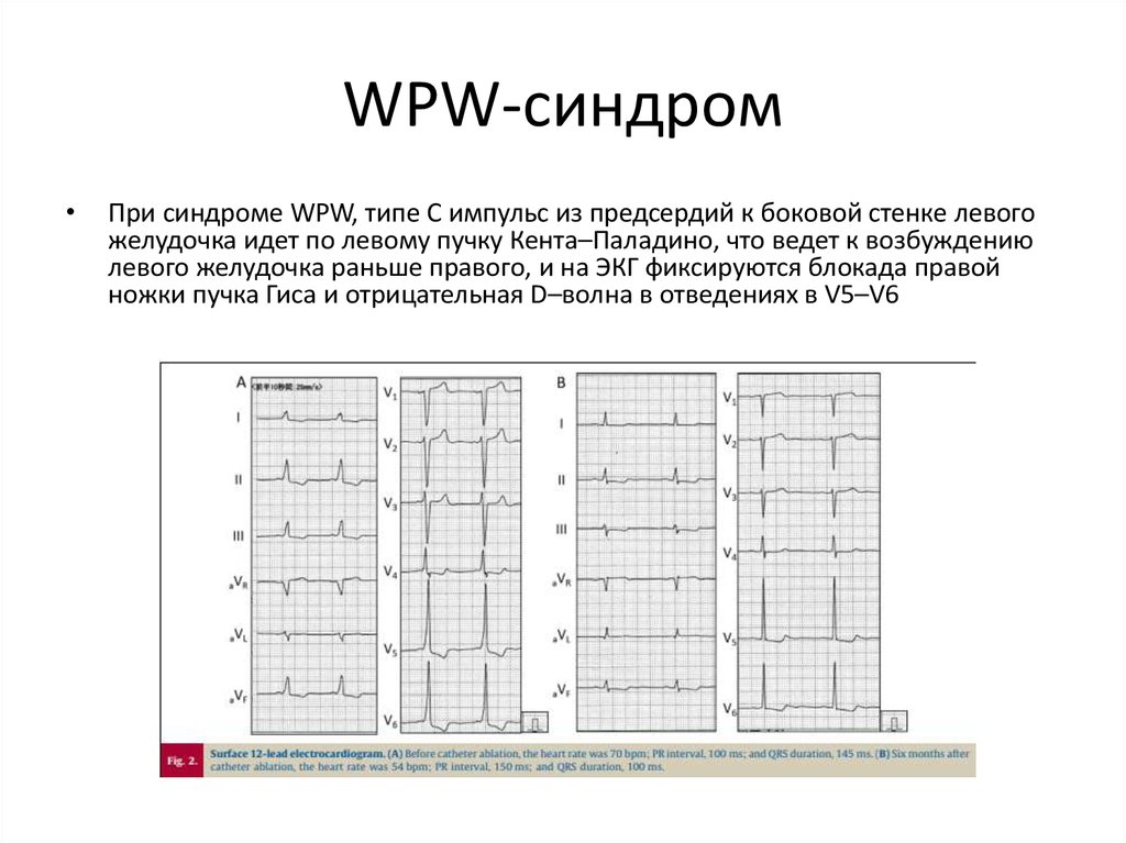 Wpw на экг фото