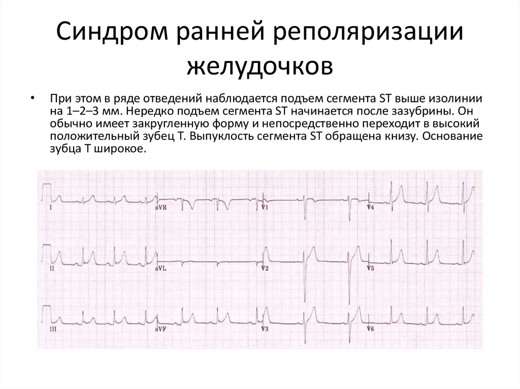 Реполяризация желудочков на экг. Реполяризация миокарда желудочков ЭКГ. Синдром ранней реполяризации желудочков на ЭКГ. Синдром (феномен) ранней реполяризации желудочков. ЭКГ ранняя реполяризация миокарда.