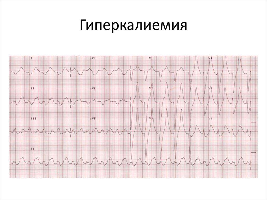 Экг при гиперкалиемии картинки