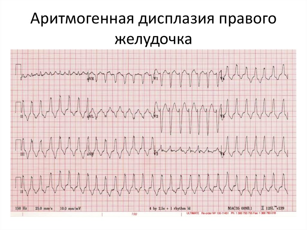 Экг при дилатационной кардиомиопатии фото