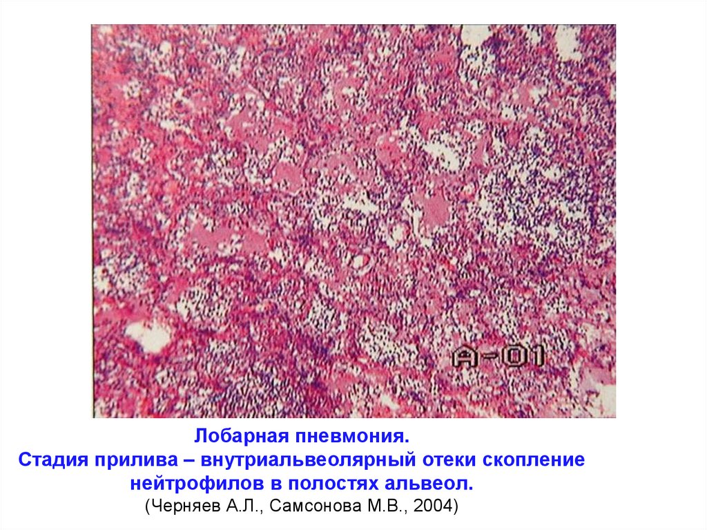 Лобарная пневмония. Стадия прилива – внутриальвеолярный отеки скопление нейтрофилов в полостях альвеол. (Черняев А.Л.,