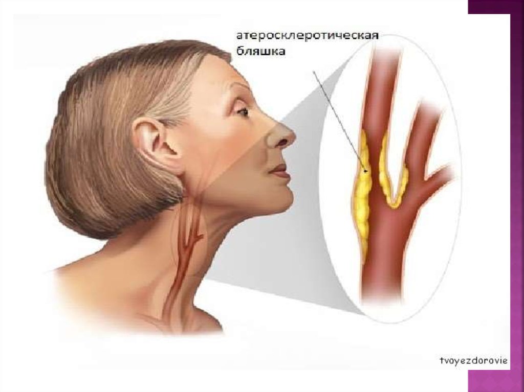 Бляшки в шейной артерии что делать. Атеросклеротическая бляшка в сонной артерии. Атеросклероз сосудов сонных артерий. Холестериновая бляшка в сонной артерии. Атеросклероз сосудов шеи сонных артерий.