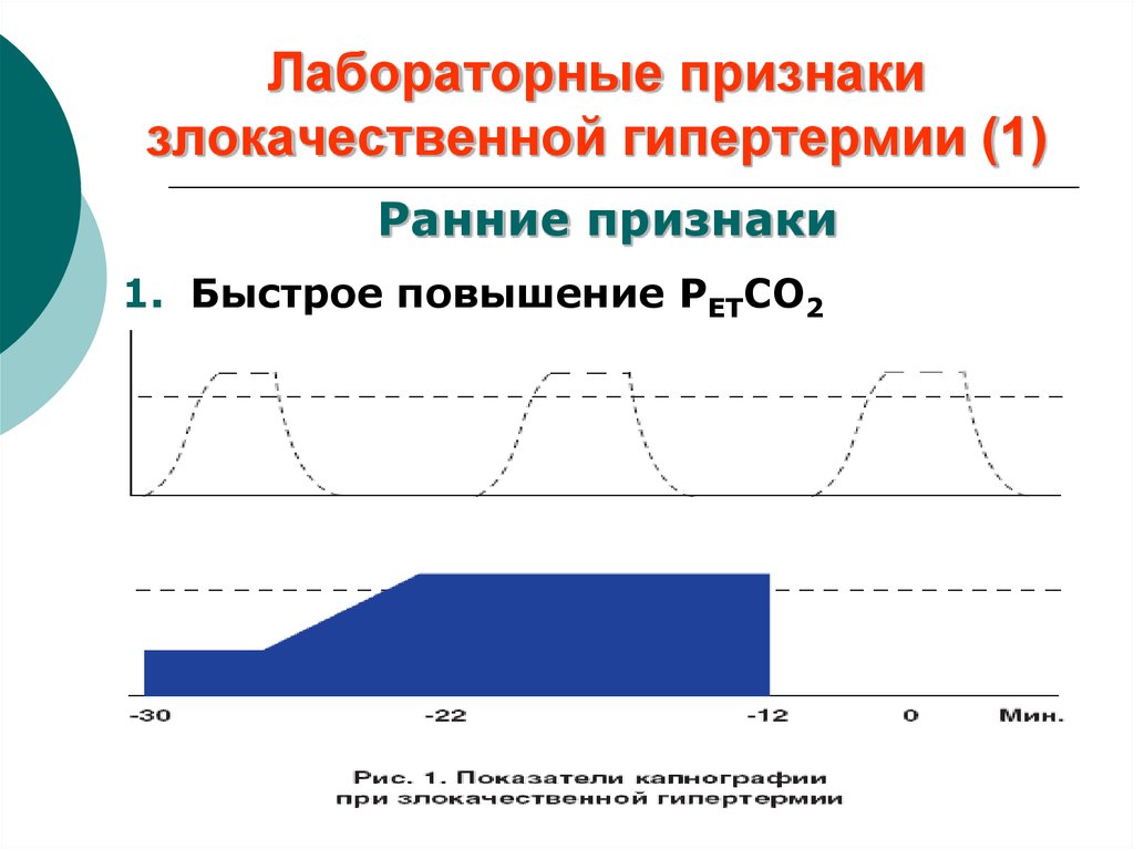 Гипертермия признаки